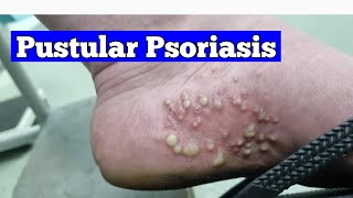 Transform Your Life Effective Strategies for Pustular Psoriasis [upl. by Gibson620]