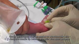 Paediatric Anaesthetics Chapter 7  Long saphenous IV neonate 1 [upl. by Nnarual]