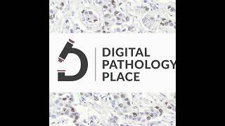 104 DigPath Digest 12 AI in Pathology From Retinal Screening to Global Cancer Diagnostics  m [upl. by Aehtla98]