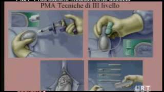 La Legge n402004 sulle tecniche di Procreazione Medicalmente Assistita [upl. by Manuela]