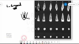 The Pulp and Acess Cavity of Maxillary central incisors [upl. by Hylan]