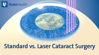 Standard vs Laser Cataract Surgery  Duke Health [upl. by Bever248]