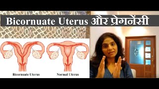 Bicornuate Uterus एक ठोस वजह गर्भ धारण न होने की  Bicornuate Uterus Treatment [upl. by Timus]