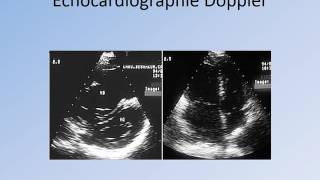 CARDIOLOGIE CAT devant une Embolie Pulmonaire [upl. by Ajtak768]