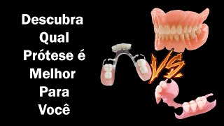 Prótese Dentária Removível  Conheça os 3 Tipos que Existem Para Substituir Dentes Perdidos [upl. by Nhguaved144]