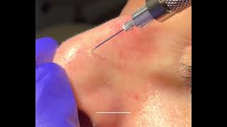 Treatment for Telangiectasia Spider Veins on the Nose  Dr Brandon Beal [upl. by Grubb]