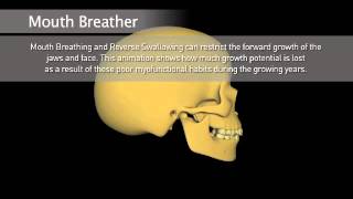 How Myobrace Works What are the causes of crooked teeth Myobrace 1 [upl. by Bradlee426]