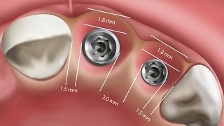 Clinical Tip Implant Placement in the Esthetic Zone Vol 5 Issue 2 [upl. by Ohcamac]