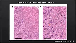 Journal club Metastatic colorectal carcinoma growth pattern in liver [upl. by Vania100]