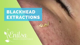 Blackhead Extractions on “K” 9 [upl. by Koller]