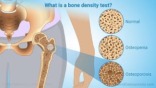 Test Panels for Bone Diseases  Osteoporosis and Fractures [upl. by Elyr886]