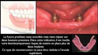 Prothèse amovible et implants dentairesMandibular overdentures [upl. by Malvia]