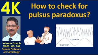 How to check for pulsus paradoxus [upl. by Rahman]