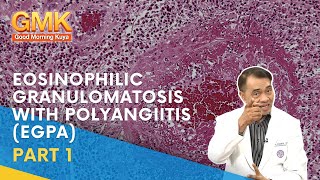 Eosinophilic Granulomatosis with Polyangiitis EGPA Part 1  Usapang Pangkalusugan [upl. by Templas]