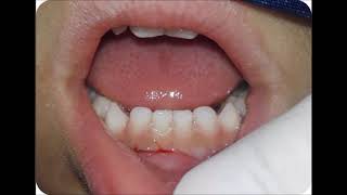 Exodoncia dientes temporales 71 y 81 [upl. by Clower]