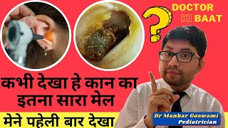 How to remove earwax  Extra large Earwax  Stone like Earwax  Best Earwax Removal video [upl. by Inele123]