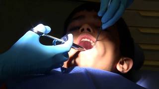 Tooth filling in school dental clinic Part 2 Tooth filling [upl. by Nyledaj]