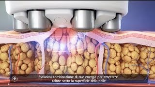 Macchinari per celluliteVenus LegacyTrattamenti anticellulite [upl. by Weinman]