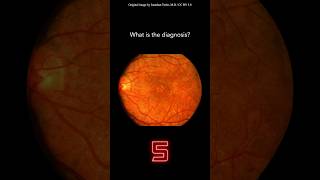 Fundoscopy Question 24 [upl. by Raynard]