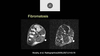 MRI of Soft Tissue Tumors  Part 2 [upl. by Eelana]