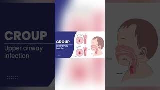 Barking cough in Croup [upl. by Dlanod]