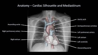 How to Interpret a Chest XRay Lesson 2  A Systematic Method and Anatomy [upl. by Inohtna]