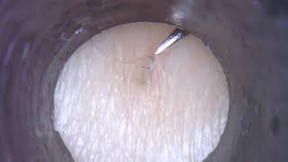 Satisfying ingrown hair removal 4 [upl. by Yelsehc]