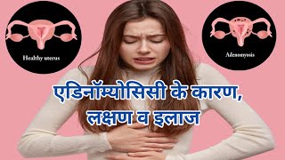 एडिनॉम्योसिस क्या होता है इसके लक्षण क्या होते है व इसके बचाव Adenomyosis Symptoms and Causes [upl. by Gelman622]