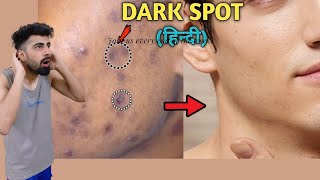 How To Remove DARK SPOTS From Face Naturally  Mridul Madhok [upl. by Namaan]