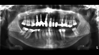 für Zahnärzte das OPTG Röntgen [upl. by Demahum753]
