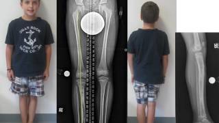 Congenital Leg Length Discrepancy Russell Silver Syndrome in Children [upl. by Eileen]