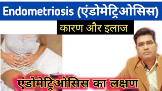 What is Endometriosis and What are its Causes Symptoms and Treatment  In Hindi [upl. by Darn605]