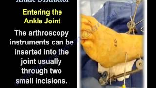 ANKLE ARTHROSCOPYThe Use Of Ankle Distractor  Everything You Need To Know  Dr Nabil Ebraheim [upl. by Nohtanhoj568]