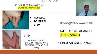 Congenital Talipes Equino Varus CTEV  Rapid Revision of Orthopaedics by Dr Prateek Joshi [upl. by Ofilia]