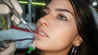 Labret  Dudak  Piercing Deldirme Sonrası İlk Değişim [upl. by Dotson]