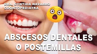 🤔😩 ¿Por qué salen abscesos o postemillas en la boca [upl. by Ahtennek]