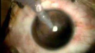 Cirurgia catarata e implantte de LIO em 4 minutos  4 minutes cataract IOL surgery [upl. by Atnoed]