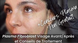 Plasma Fibroblast Visage AvantAprès  Giveaway  Je Vous dis Tout [upl. by Durer]