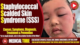 Staphylococcal Scalded Skin Syndrome SSS  Causes Symptoms Treatment  Lancet Infectious Diseases [upl. by Nalyorf]