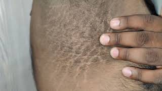 Acanthosis Nigricans [upl. by Georgeanna471]