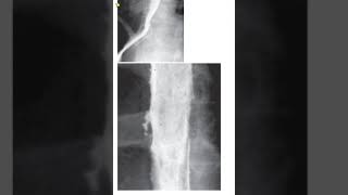 Differential diagnosis of Esophageal ulcers shorts [upl. by Melgar767]