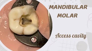 Access opening of Mandibular Molar [upl. by Rozalin731]