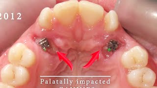 HOW BRACES WORK  TIMELAPSE of Impacted Canines  6 MONTHS treatment BEFORE and AFTER [upl. by Aehsat]