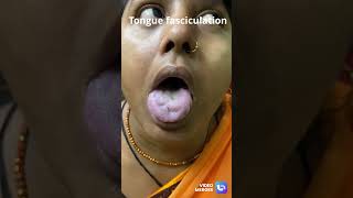 Tongue fasciculation Seen in LMN diseases like ALS hypoglossal neuropathy brain stem lesion etc [upl. by Elokin]