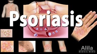 Psoriasis Types Symptoms Causes Pathology and Treatment Animation [upl. by Mikey558]