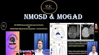 By Dr Ramesh Krishnan Neurologistnmosd diseaseoptic neuritismogad diseasemultiple sclerosis [upl. by Cher]