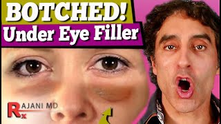 BOTCHED UNDER EYE FILLER  Under Eye Filler [upl. by Gabi399]