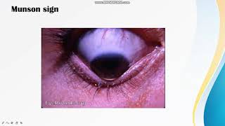 Signs of Keratoconus [upl. by Aitnic61]