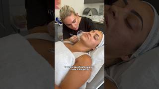 Acne Scarring Treatment with TCA CROSS Session at Dr Medispa [upl. by Seem]