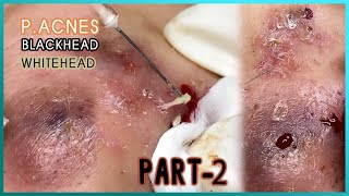 Big Cystic Acne Blackheads Extraction Blackheads amp Milia Whiteheads Removal Pimple Popping [upl. by Labanna773]